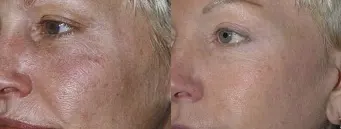 before-after-img2