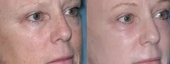 before-after-img3